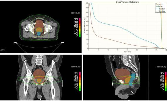 A radiotherapy plan for a patient with prostate cancer showing the clinical target volume, which includes the prostate (orange), bladder (brown), rectum (blue) on the axial (top left), coronal (bottom left), and sagittal (bottom right) plane with isodose levels as well as the corresponding dose volume histogram (DVH) (top right).